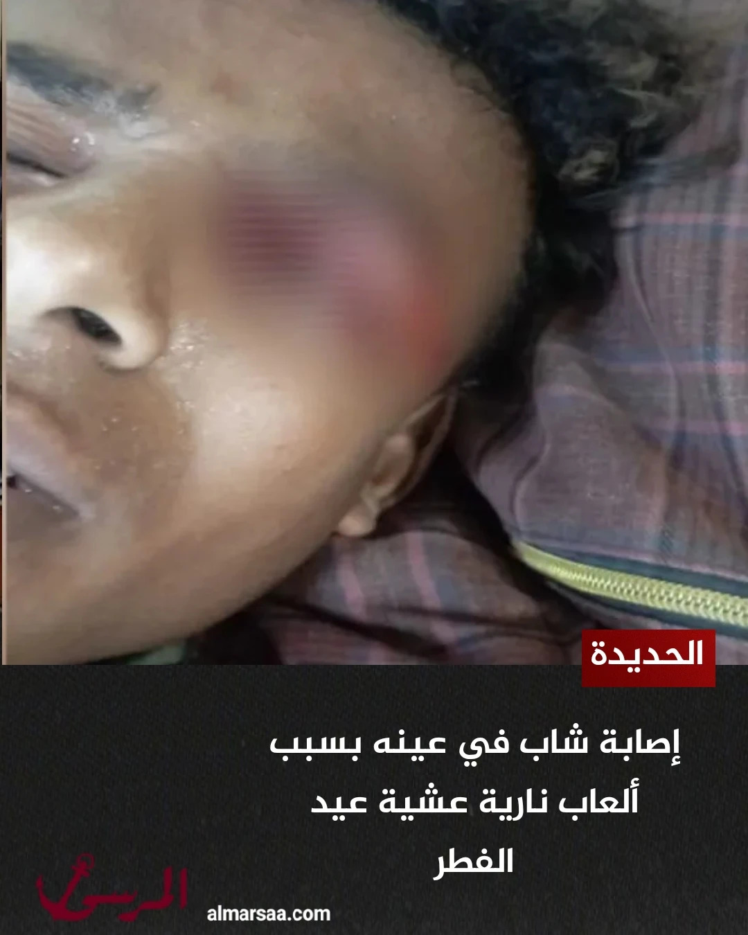 الحديدة.. إصابة شاب في عينه بسبب ألعاب نارية عشية عيد الفطر