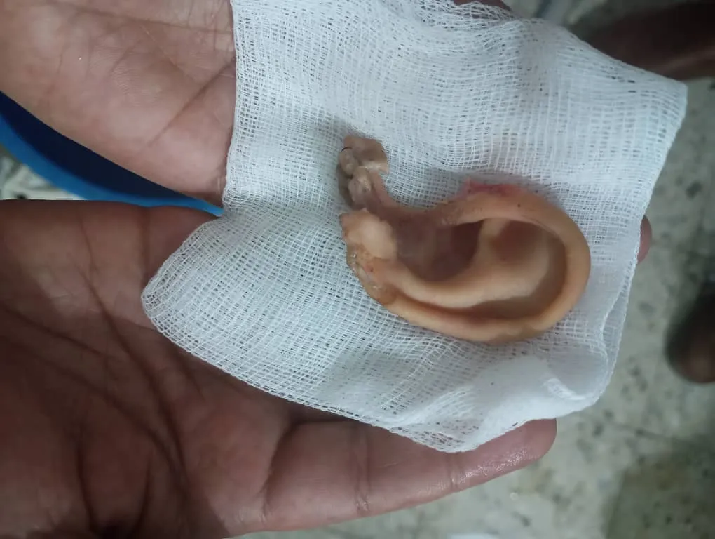 الألعاب النارية تتسبب في قطع اذن طفلة بالضالع..(صور)