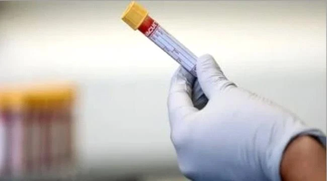 تطوير اختبار دم يساعد فى تشخيص سرطان الغدد اللمفاوية لدى الأطفال