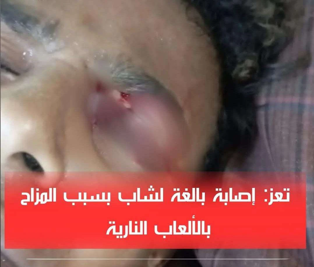 إصابة خطيرة لشاب بسبب المزاح بالألعاب النارية