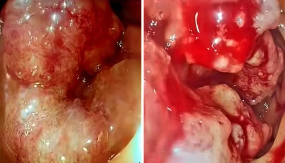 قصة مؤلمة تهز صنعاء.. طبيب يروي مأساة فتاة ظنت المرض بسيطا فخطفها السرطان قبل زفافها