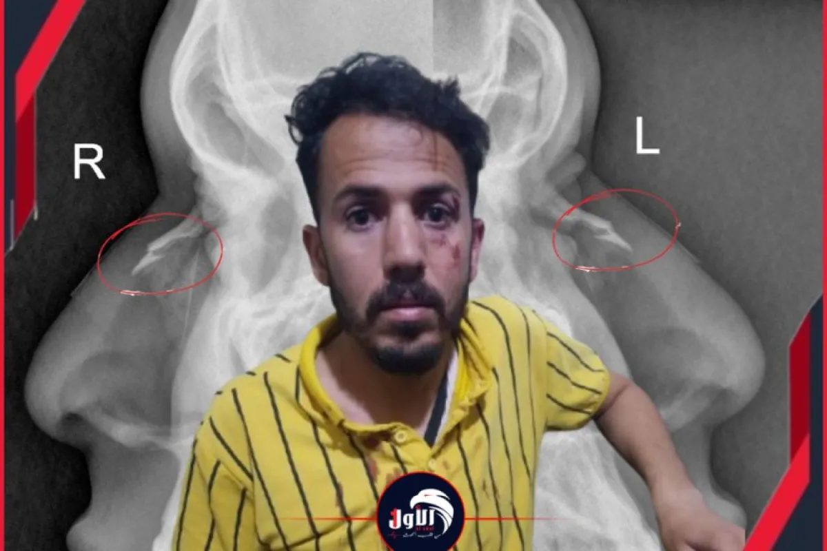 بالصور: بين كسر الأنف ونزيف العين.. تفاصيل الاعتداء الهمجي على (حكم) مباراة ديربي صنعاء!