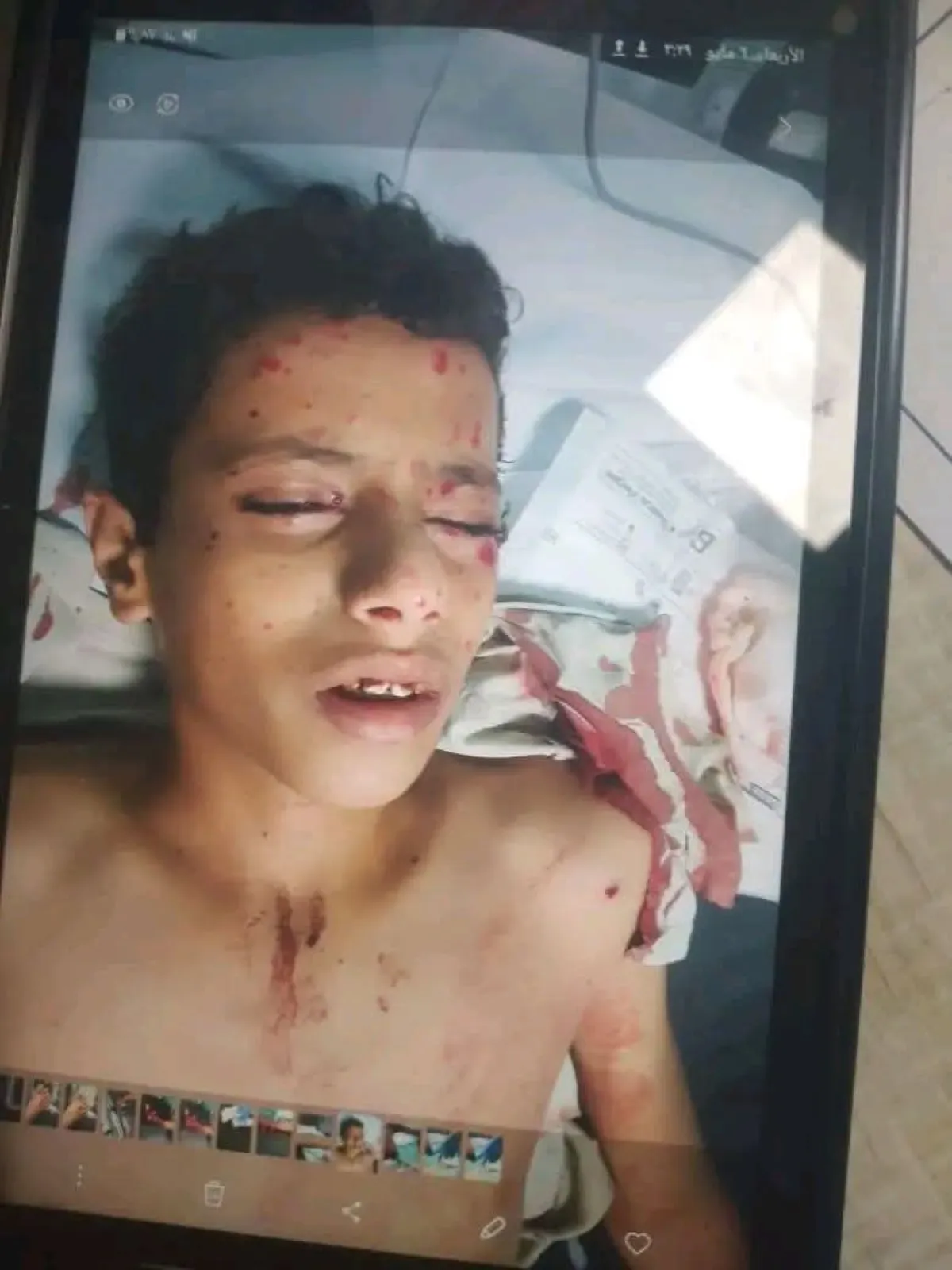 إصابة طفل بالضالع بانفجار صاعق من مخلفات الحرب