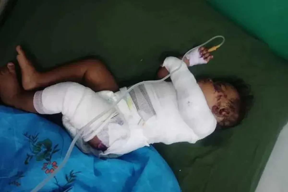 الحديدة: إصابة طفلين بحروق إثر حريق منزل في بيت الفقيه