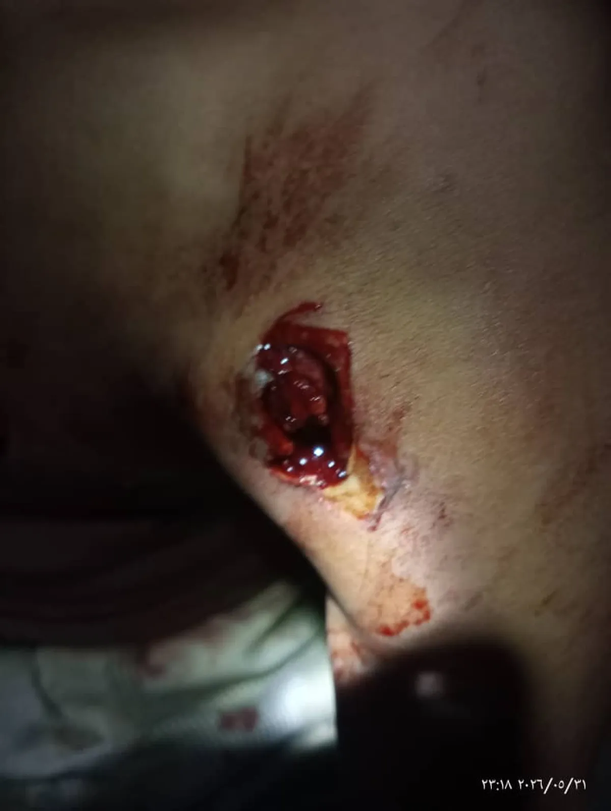 لحج : إصابة فتى بقصف عشوائي شنته مليشيا الحوثي على قرى المسيمير