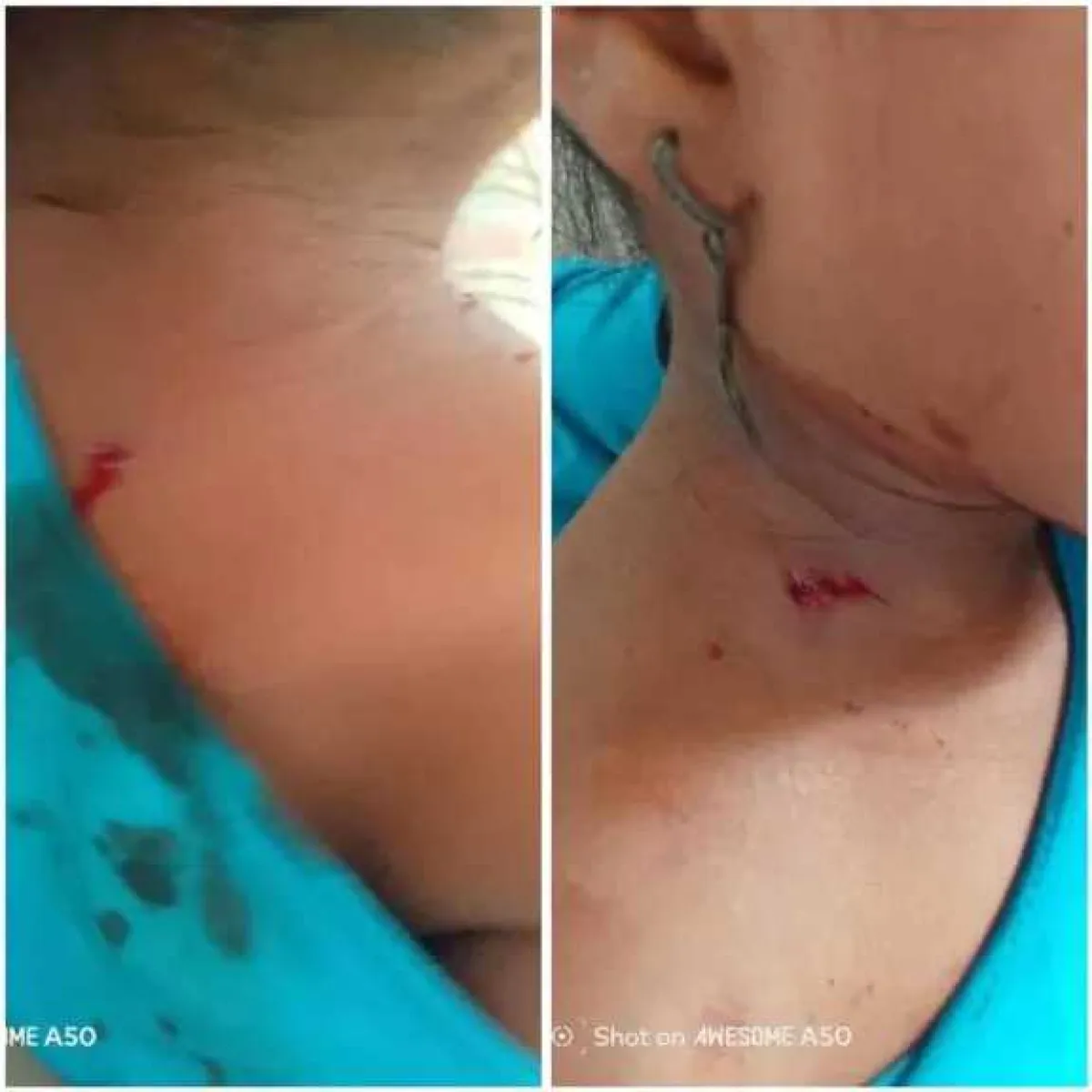 إصابة طفلة برصاص قناص حوثي في تعز